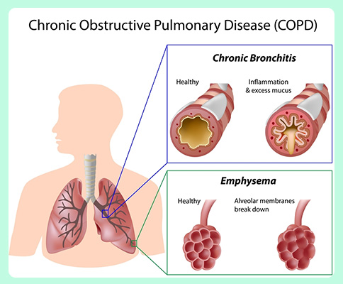 COPD Details