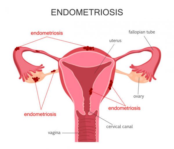 Endometriosis diagram. Diseases of the female reproductive system. Vector illustration
