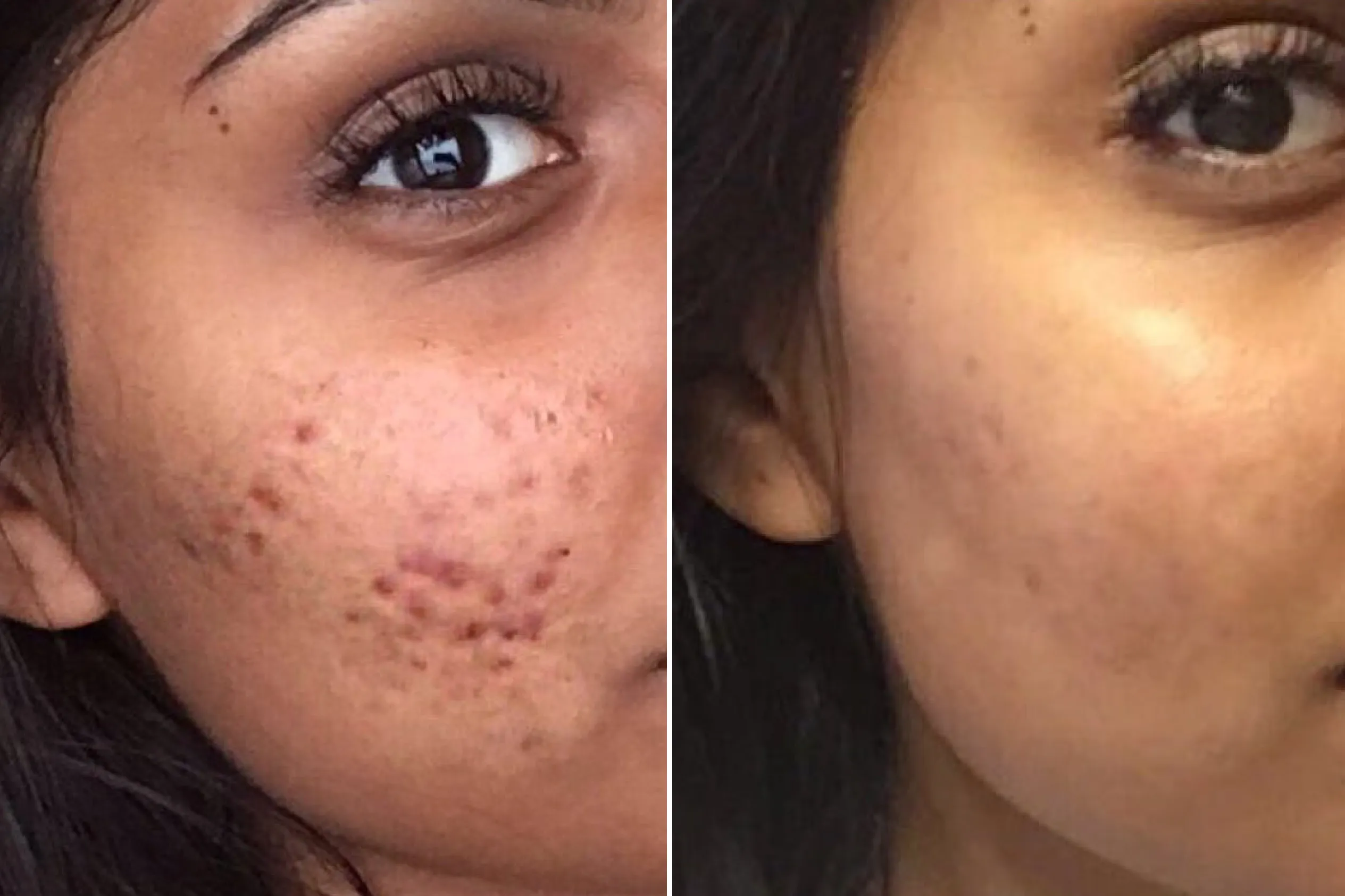 acne routine before and after