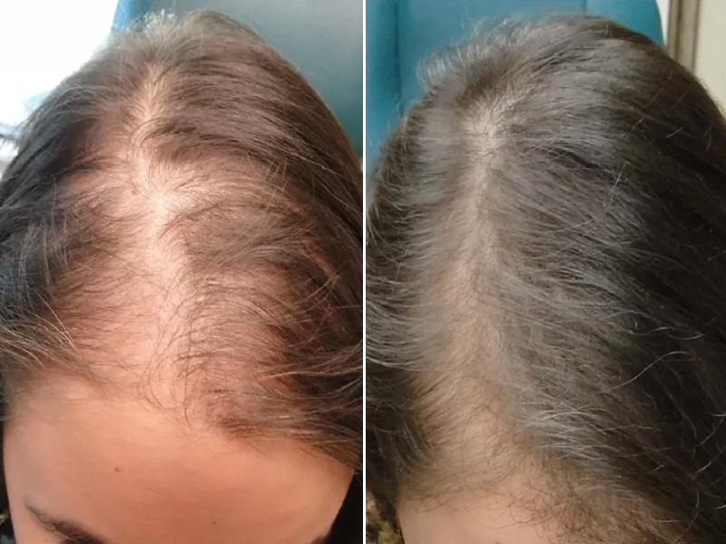 hair fall female before and after