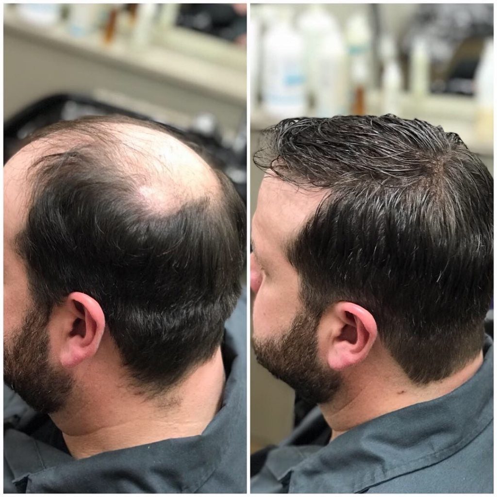 hair fall male before and after