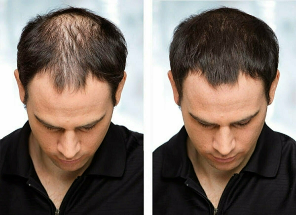 hair fall male before and